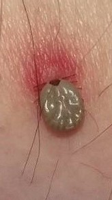 吸血中のマダニの写真