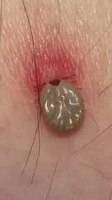 吸血中のマダニの写真