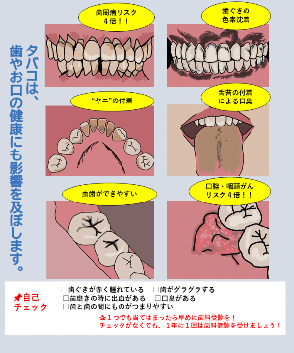 たばこと歯周病の関連に関するイラスト